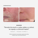 Experiență reală Ivatherm Cicaderm: comparație înainte și după pentru piele iritată și înroșită